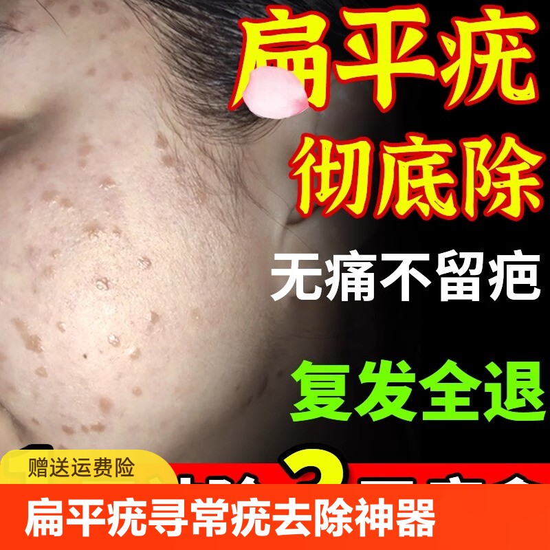 扁平疣面部去除膏丝状疣治疗祛疣瘊子寻常跖疣神器专用药膏一抹灵