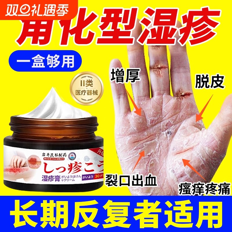 角化型湿疹手癣膏脱皮干裂真菌感染角质化皲裂性湿疹手癣足癣药膏