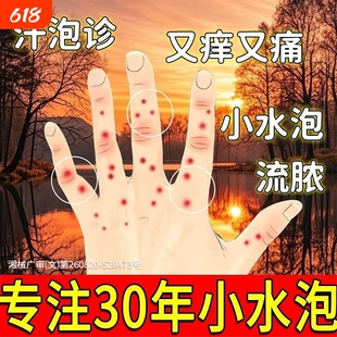汗疱疹汗泡疱疹药膏汗孢疹去手上起小水泡手痒汗状湿疹止痒皮炎