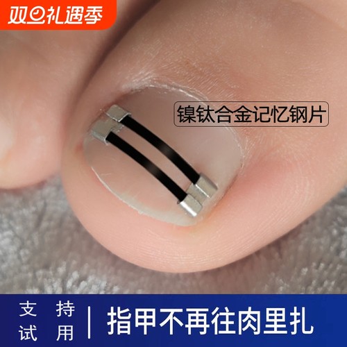 镍钛记忆回弹钢片嵌甲矫正器