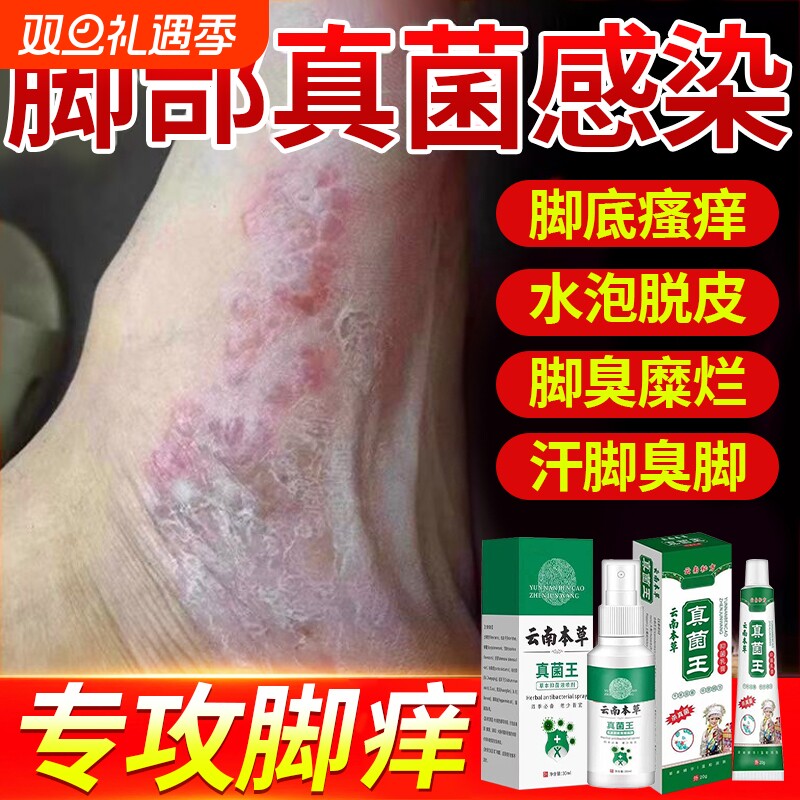 脚喷雾止痒脱皮杀菌真菌感染专用脚痒水泡烂脚丫效药特药膏