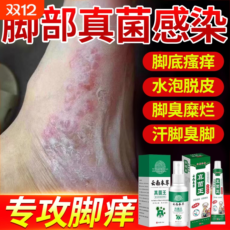 脚喷雾止痒脱皮杀菌真菌感染专用脚痒水泡烂脚丫效药特药膏