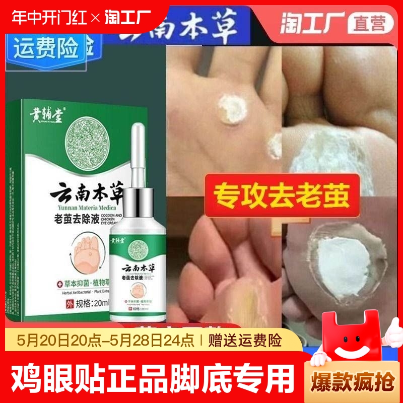 云南本草鸡眼贴鸡眼膏瘊子足部去脚底脚趾部跖疣灵老茧根肉刺药膏