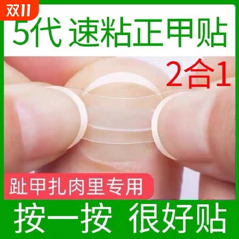 正甲贴片矫器内嵌扣德国沟卷