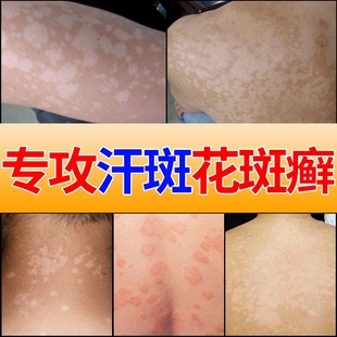 汗斑净喷剂皮肤去花斑膏非药汗癍水汉斑喷雾汗班净香露皂汗斑专用