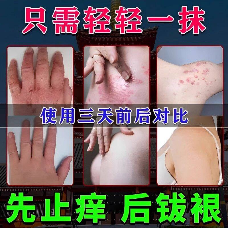 专治神经性湿毒皮炎疹止痒特效去除根外用顽固治脂肪溢性瘙痒药膏