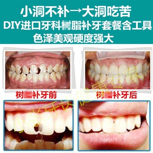 进口树脂补牙自己补牙材料补牙补牙齿 补牙缝配工具有说明视频