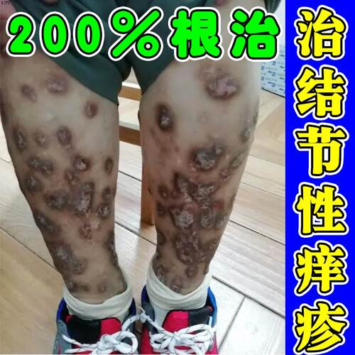 结节性痒疹特治顽固效硬疙瘩胳膊小腿上治疗皮肤瘙痒全身痒专用膏