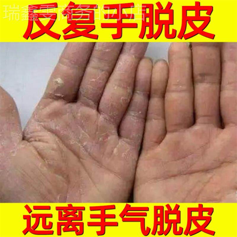 喷剂手脱皮药膏真菌感染除螨手脚后跟老专家后背去鲜背后擦手