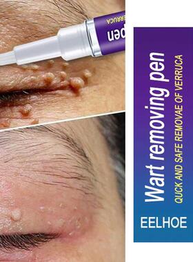 Removal Of Warts Liquid Pen Woman Skin Care Removing Against