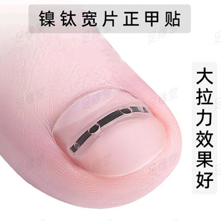 嵌甲矫正钢丝钢片甲沟贴片正甲贴物理拉平指甲不在往肉里长修脚炎