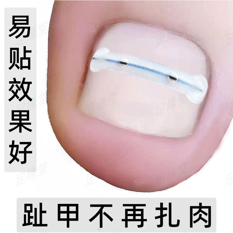 TPU塑胶正甲贴镍钛合金钢丝指甲矫正贴片甲沟嵌甲卷炎拉平正甲贴,家庭/个人清洁工具,美甲/修甲套装,淘宝优惠券,粉丝福利购,淘宝优惠卷