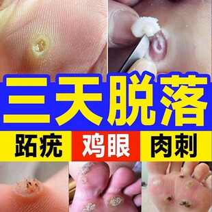 鸡眼膏贴跖疣寻常疣瘊子非药膏手部辅助去除疣灵除足部疣脚底肉刺