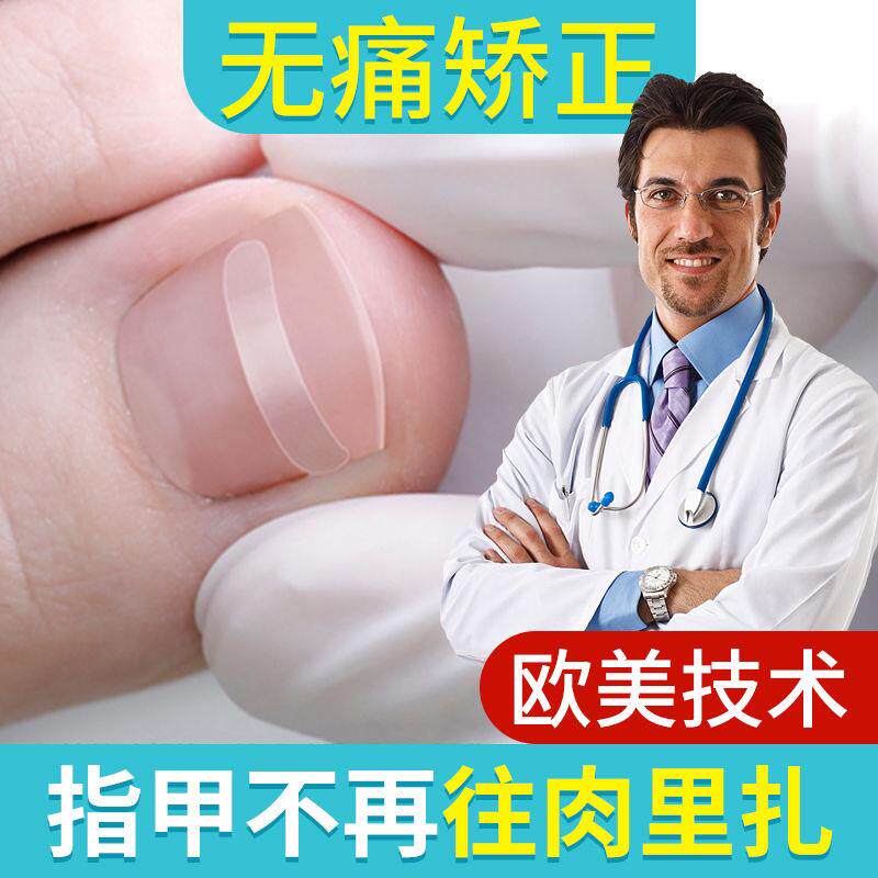 正甲贴甲沟嵌甲矫正器脚趾甲炎拉浴足剂