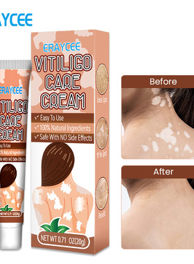 ERAYCEE跨境外贸Temu joom 亚马逊独立站白斑膏汗斑花斑身休护理