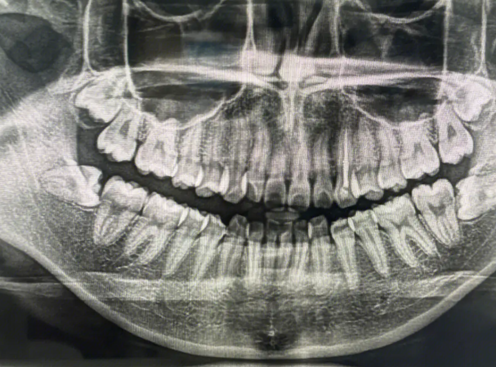 骨埋伏阻生智齿图片