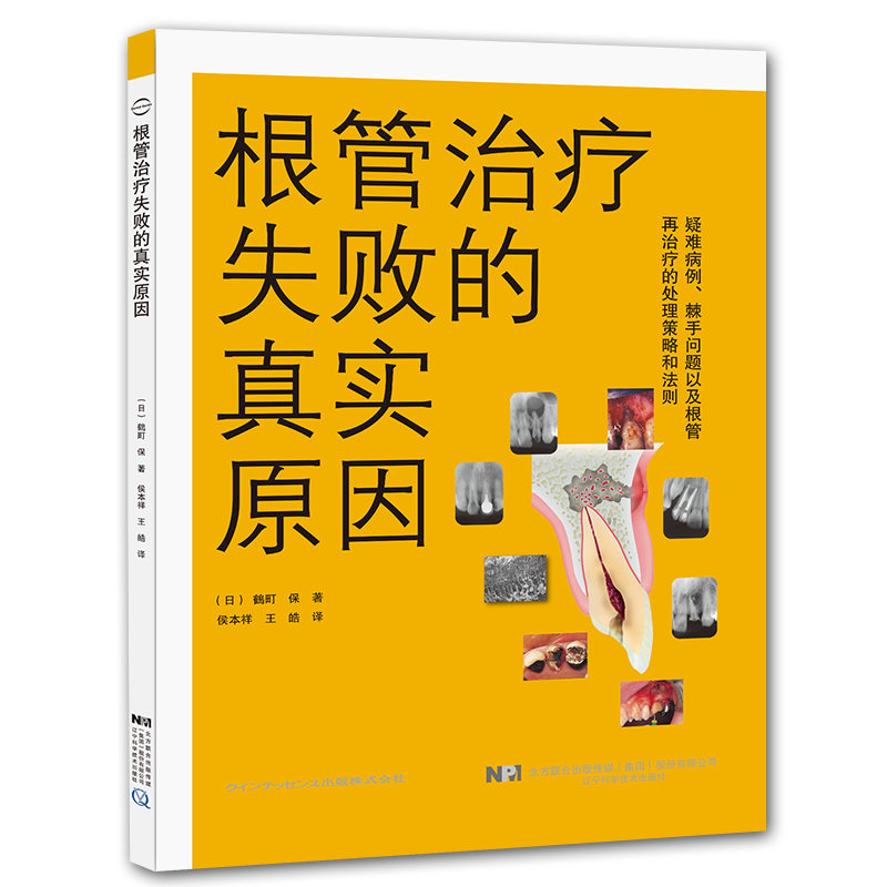 现货根管治疗失败的真实原因