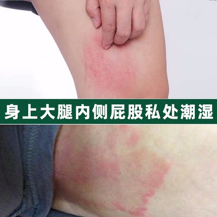 大腿内侧皮肤瘙痒股藓止痒去睾丸痒下体根裆部男性阴囊潮湿抑菌膏