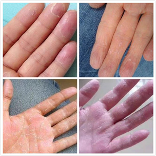 治手脚掌心水泡皮肤痒外用药全身皮肤手脚干痒真菌抑菌止痒膏