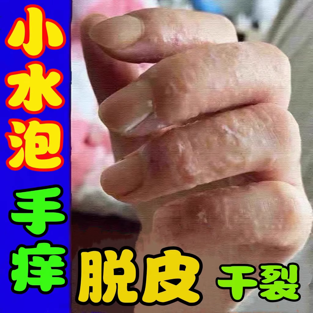 苗瑞堂治手脚水泡开裂脱皮皮肤外用抑菌药手气反复干燥脱皮止痒膏