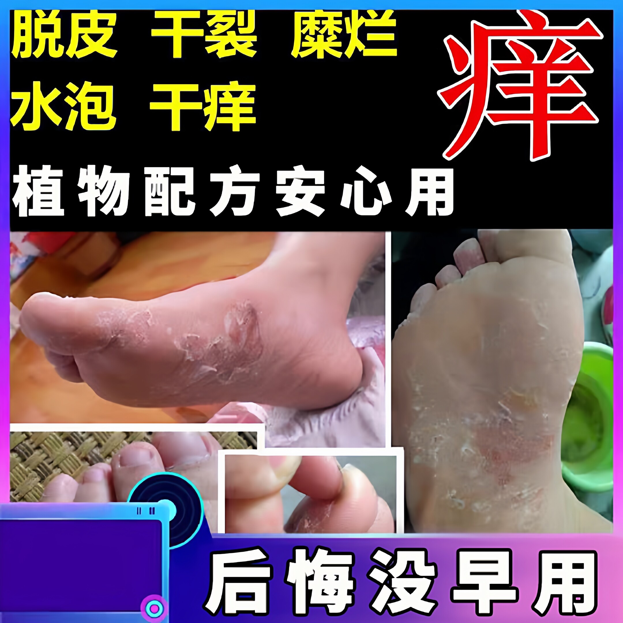 脚底脱皮膏脚干裂退皮脚起皮脚蜕皮死皮脚爆皮治脚臭止痒膏反复药