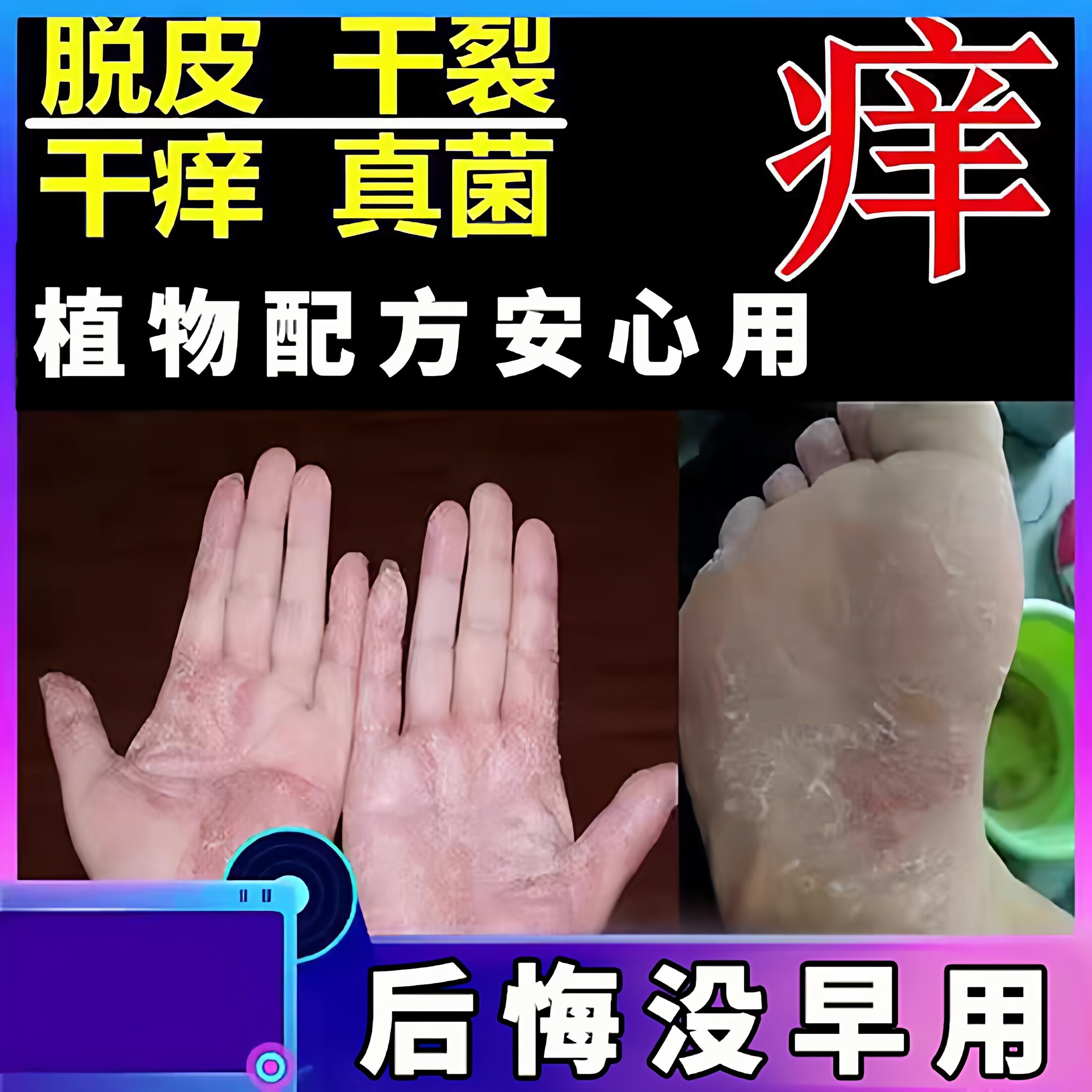 手脚痒脱皮膏手上小水泡蜕皮手起皮季节手爆皮修复膏止痒膏反复膏