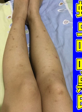蚊虫叮咬黑印淡化黑色素去沉淀去豆疤印修复腿上挠印痘印伤烫疤痕
