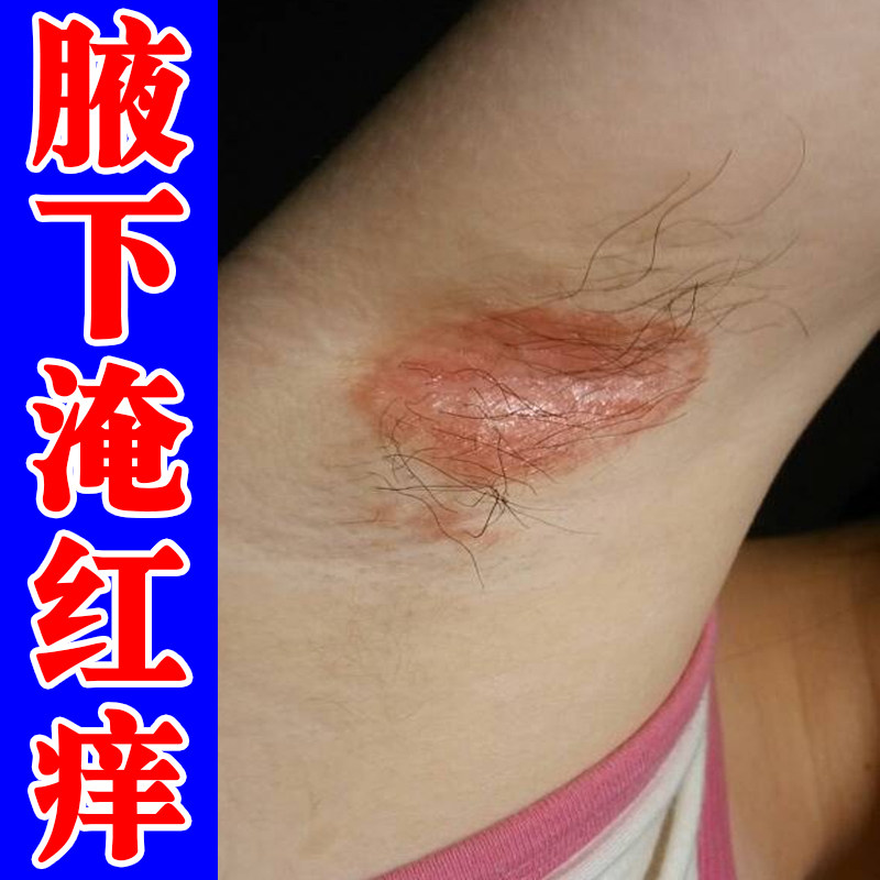 冶腋下淹红的药防腋窝胳肢窝红斑淹了红斑痛夏季腋窝有异味汗 - 实物图