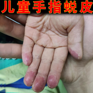 儿童手严重起皮掉皮蜕皮干燥起皮小孩儿手指手掌掉皮防蜕皮外用膏