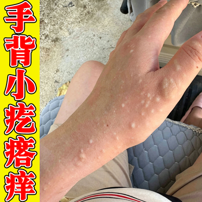 手背小疙瘩痒汗状痒手上长小水泡季节性手脱皮手痒外用膏