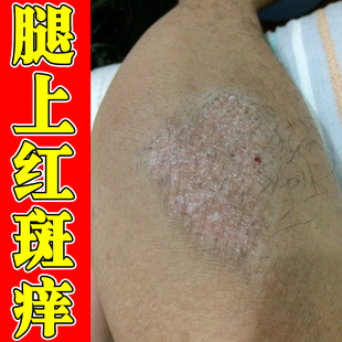 腿上疙瘩痒大腿内侧痒长小点疙瘩秋冬小腿痒腿部痒外用药