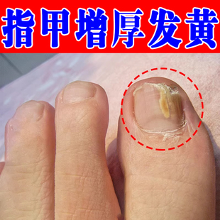 脚指甲发黄变厚变硬真菌性白甲脚指甲发黄变厚增厚指空甲肉床分离