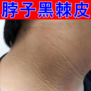 脖子黑外用药身上黑印沉淀脖子黑色素沉淀小孩儿童脖颈黑黑膏