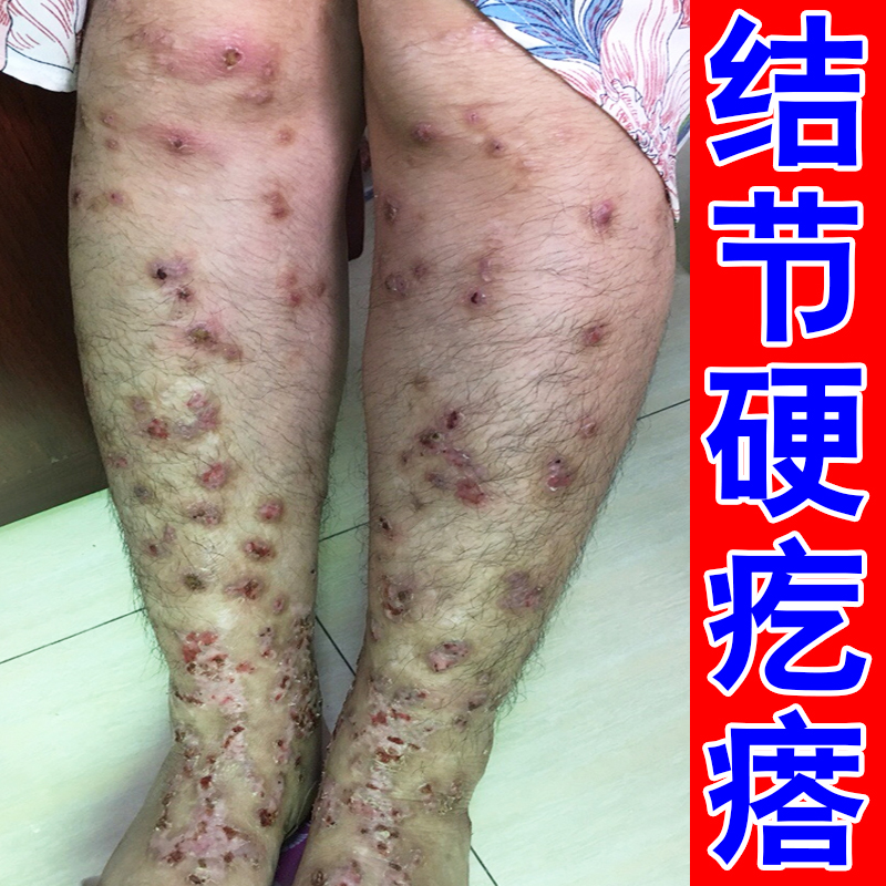 结节性硬疙瘩小腿痒腿上长红斑丘疹皮肤过敏身上痒起红疙瘩外用膏