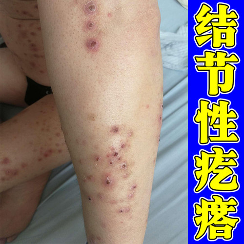 结节痒疙瘩小腿干燥粗糙长硬结红肿丘硬块痘全身皮肤过敏痒外用药