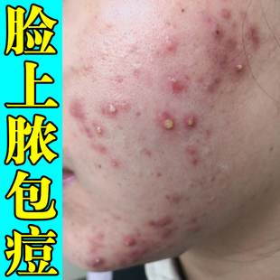脸上脓包痘痘红肿疙瘩疼痛痒熬夜上火学生脸颊长痘痘腮边痘外用膏