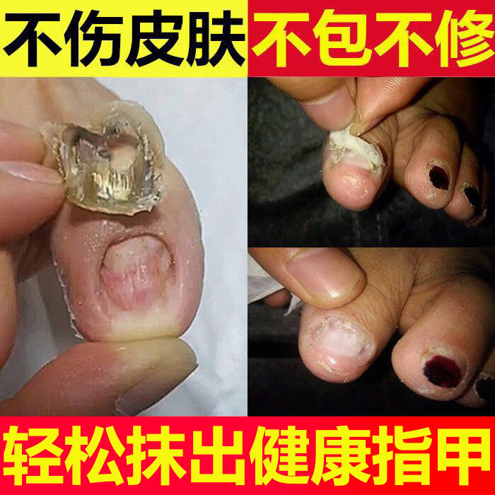 指甲营养油修复液受损再生养甲床增厚薄软竖纹滋养保护理生长水液