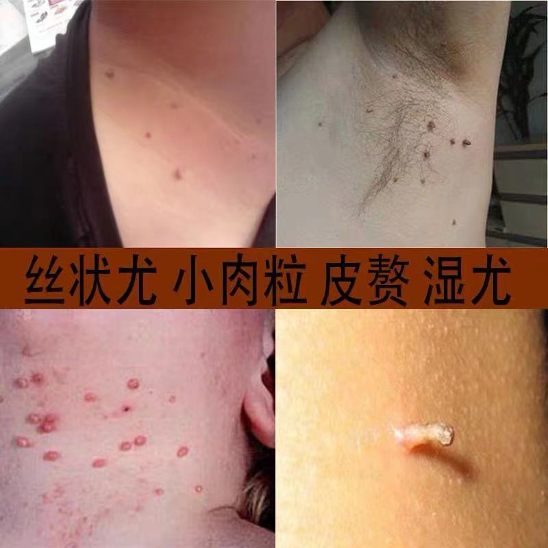 祛猴子脖子上长小肉粒疙瘩腋下痦子去除神器刺瘊子赘药点肉痣凸痣