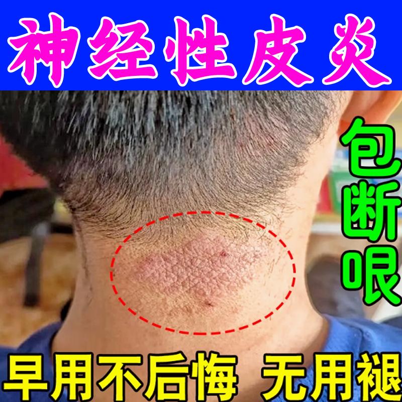 七草专治神经性皮炎根去除皮肤反复瘙痒湿疹真菌感染止痒特效膏f