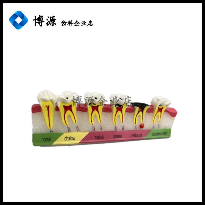 口腔讲解模型牙科教学磨形龋齿病例进展医患沟通齿科材料疯狂促销