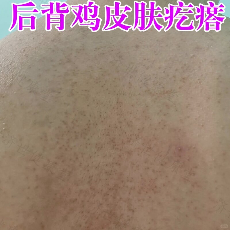 后背鸡皮肤疙瘩毛周角化毛囊堵塞腿上胳膊上长黑点红点粉刺痘痘药