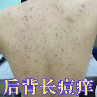 身上痒起红疙瘩痒止药前胸后背都长痘痘毛囊角化过度外用软膏