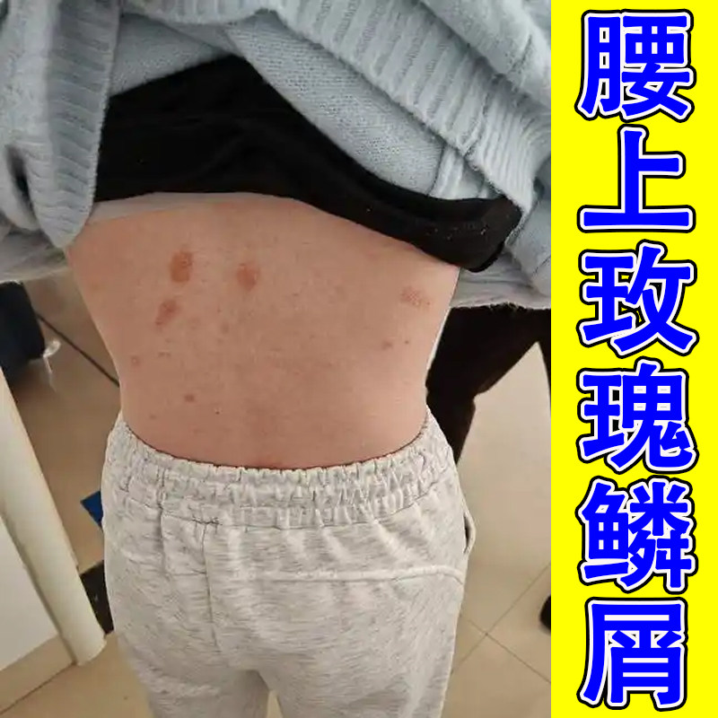 玫瑰糠专用乳膏红斑药除日光性紫外线晒伤脂溢性后背痒外用膏
