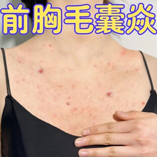 前胸后背痘痘痒止药身上真菌感染毛囊角化过度堵塞毛孔外用膏