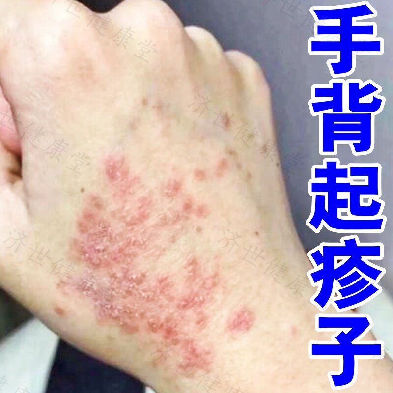专攻手背湿痒疹痒止汗疱诊手背起疹子瘙痒神经性皮肤炎专用过敏药