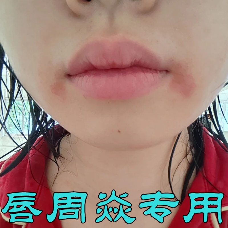 唇周围焱润唇膏专用嘴唇干裂起泡脱皮嘴角裂保湿滋润男女通用唇膏