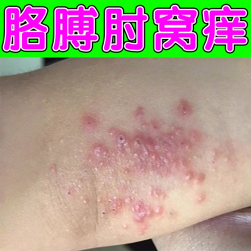 胳膊肘痒外用软膏手肘窝起小疙瘩红点痒皮肤感染抓出血痒的修复药