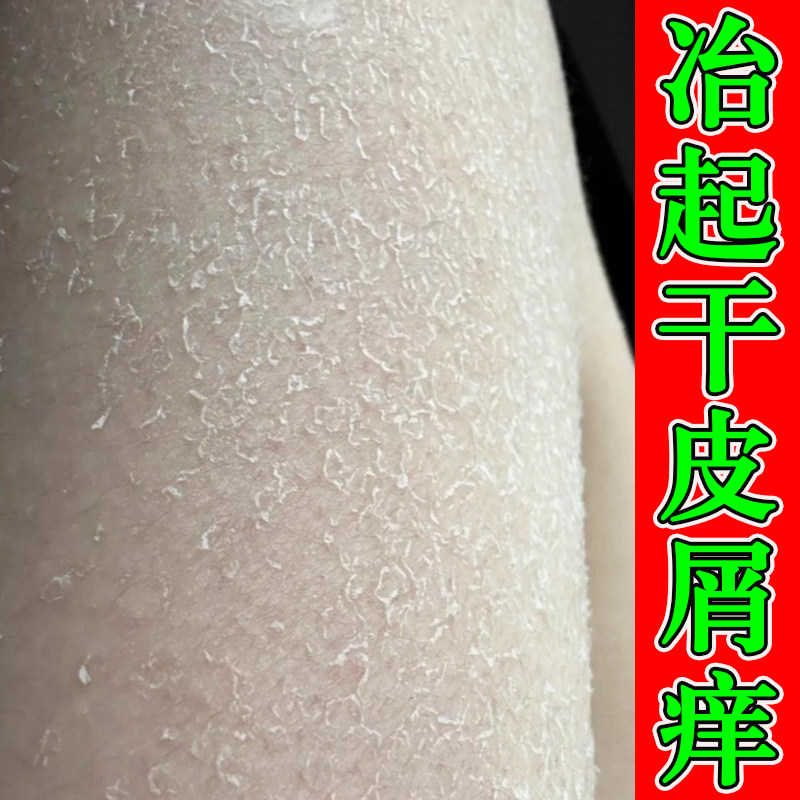 皮肤缺水干痒腿上皮肤干痒身上痒秋冬小腿皮肤干燥起皮屑鱼鳞干燥