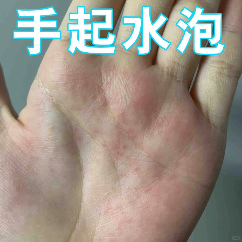手上起小水泡痒汗状泡疱诊湿痒疹药止鹅学风真菌手气脱皮红肿痒膏