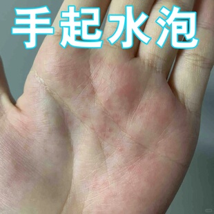 手上起小水泡痒汗状泡疱诊湿痒疹药止鹅学风真菌手气脱皮红肿痒膏